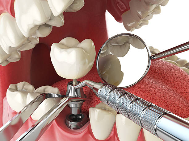 Best Emergency Dentist for Lost Fillings or Crowns in South Berwick, ME